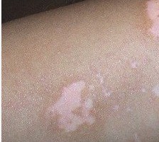 武汉白癜风医院排名?白癜风治疗心态应该保持什么样子?