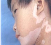 武汉最好的白癜风医院?男性经常性的应酬会不会影响白癜风的治疗?