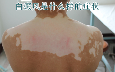 白癜风发病是哪些引起的 白癜风发病是哪些引起的
