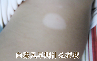 白癜风护理要注意哪些事项 白癜风护理要注意哪些事项