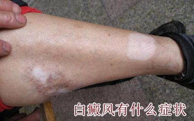 常见的白癜风治疗方法有哪些 常见的白癜风治疗方法有哪些